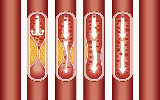 Coronary-artery-calcificati