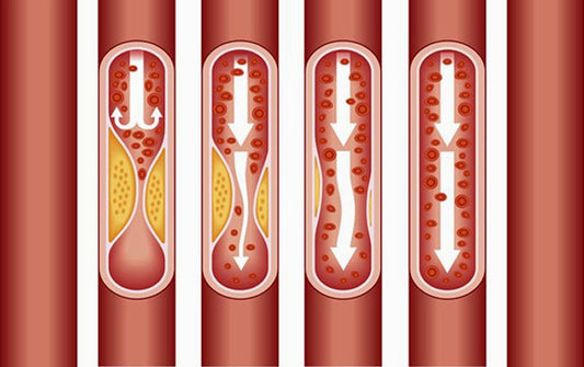 Coronary-artery-calcificati