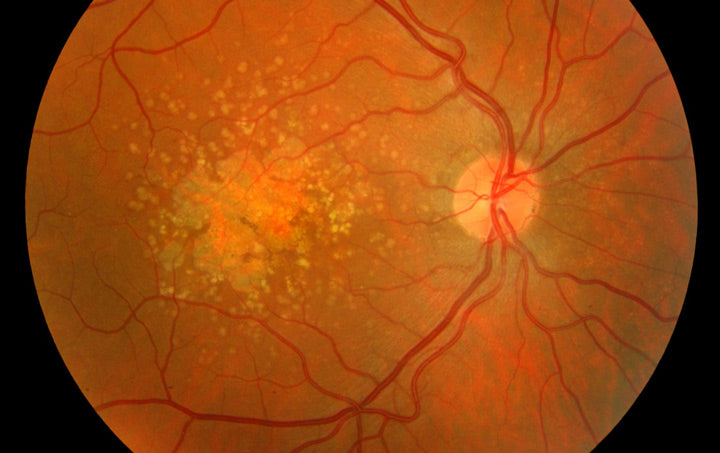 Macular-degeneration