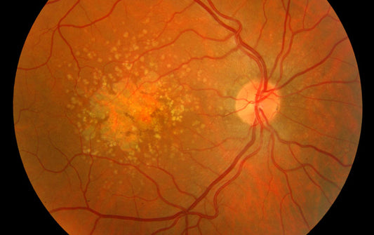 Macular-degeneration