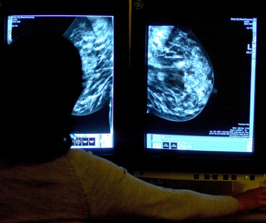 Breast cancer relapse