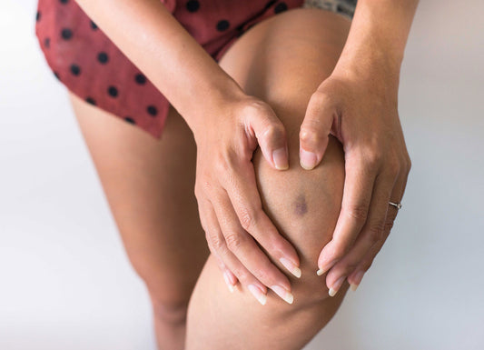 Picture of a person holding their knee to the camera and showing a small purple bruise. Bruising Capillary